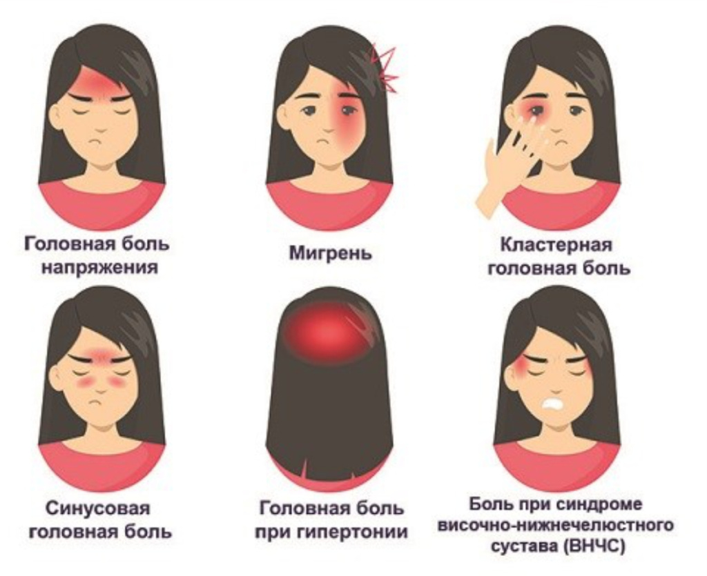 Возможная локализация разных видов головной боли